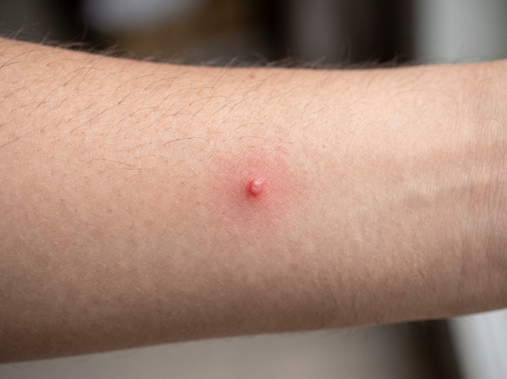 Close-up of a fresh stag beetle bite mark on a finger showing two small red pinch points and mild swelling