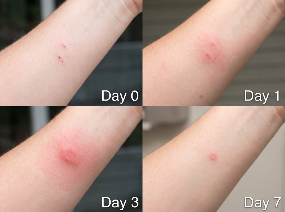 Side-by-side comparison photo of a stag beetle bite mark next to a blister beetle chemical burn on skin, labeled for identification